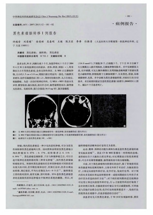 黑色素瘤脑转移1例报告