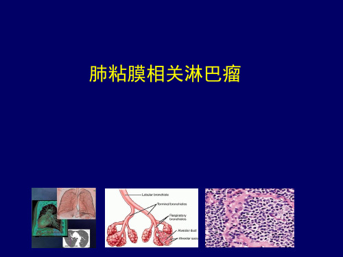 肺黏膜相关性淋巴瘤