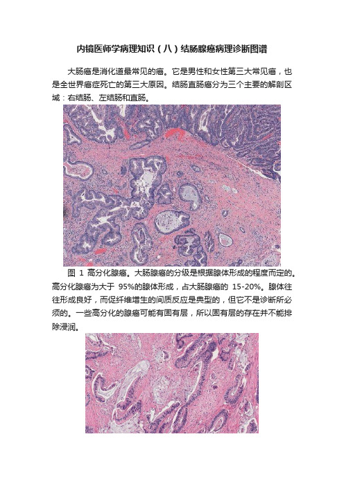 内镜医师学病理知识（八）结肠腺癌病理诊断图谱