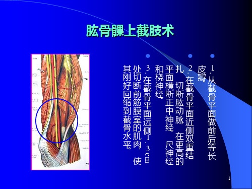 肱骨髁上截肢术PPT课件