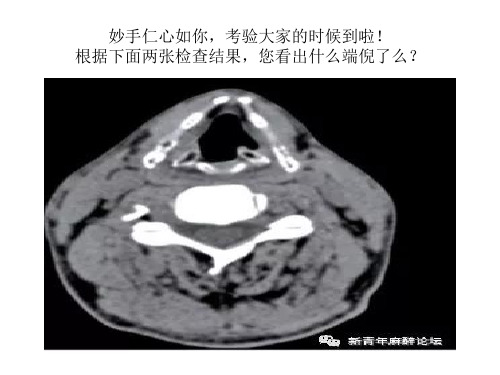 环杓关节脱位