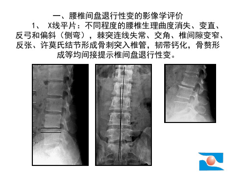 腰椎退变课件