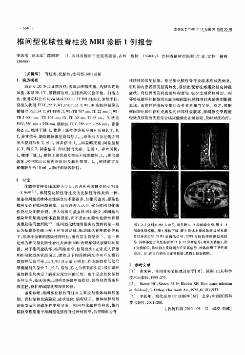 椎间型化脓性脊柱炎MRI诊断1例报告