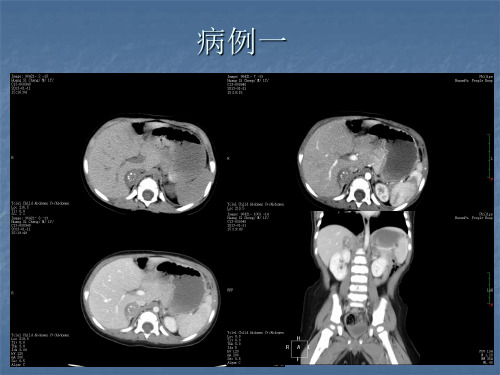 肾上腺神经母细胞瘤的CT诊断及鉴别诊断