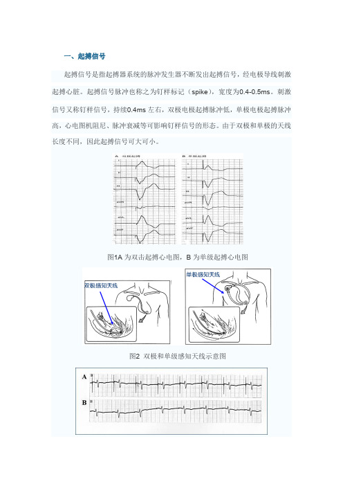 起搏心电图相关概念