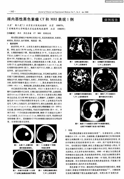 颅内恶性黑色素瘤CT和MRI表现1例