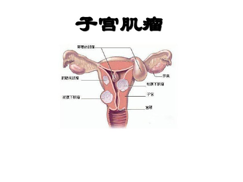 子宫肌瘤课件PPT课件