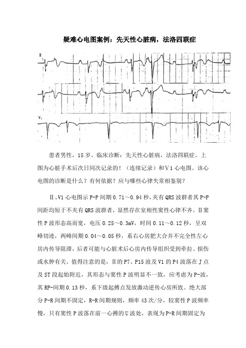 疑难心电图案例：先天性心脏病,法洛四联症