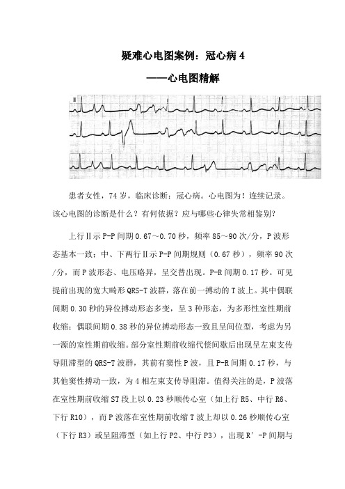 疑难心电图案例：冠心病4——心电图精解