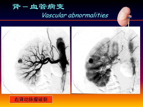 肾脏病变影像诊断2