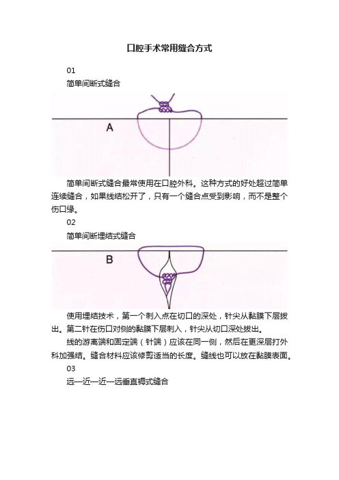 口腔手术常用缝合方式