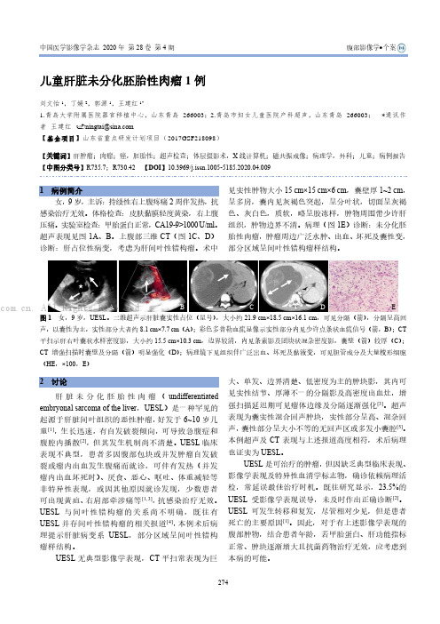 儿童肝脏未分化胚胎性肉瘤1例