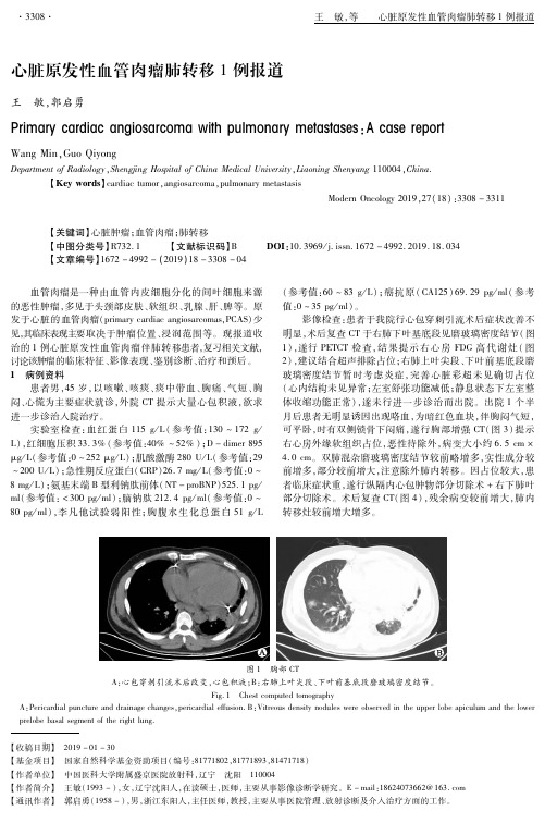 心脏原发性血管肉瘤肺转移1例报道