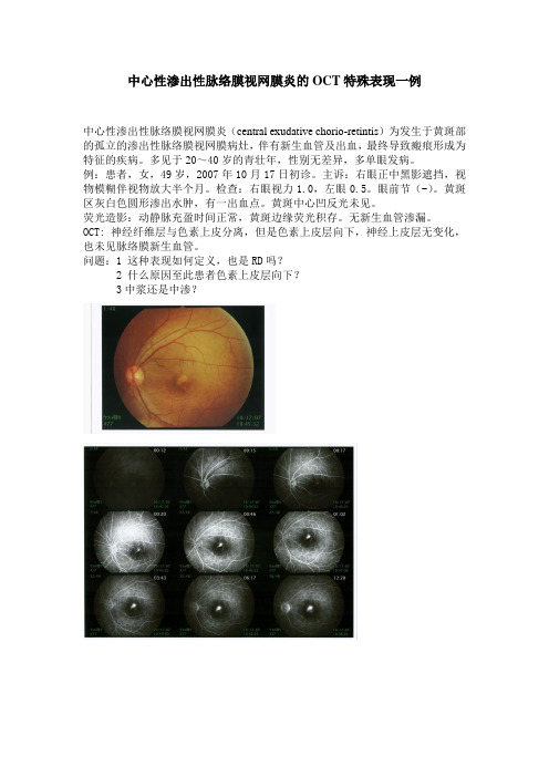 中心性渗出性脉络膜视网膜炎的OCT特殊表现一例