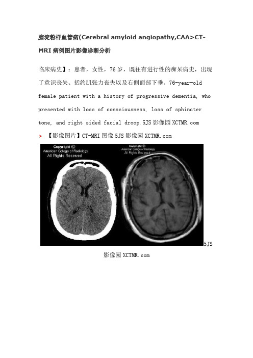 脑淀粉样血管病