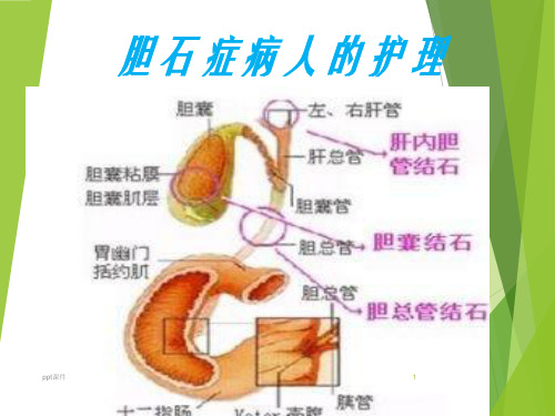 胆石症病人的护理  ppt课件