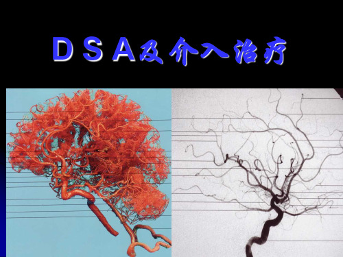 DSA入治疗课件