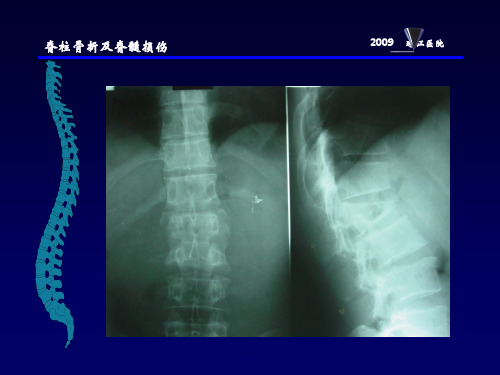 脊柱骨折与脊髓损伤ppt课件