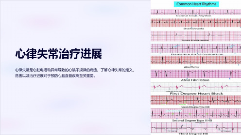 心律失常治疗进展