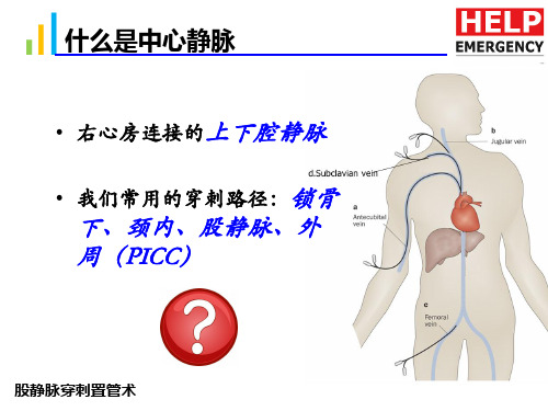 医学课件股静脉穿刺置管术