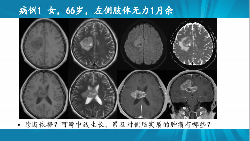 胶质母细胞瘤【影像科】 ppt课件