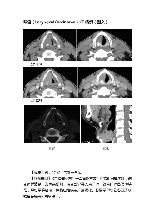 喉癌（LaryngealCarcinoma）CT病例（图文）