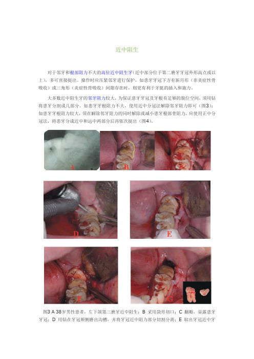 阻生牙拔除