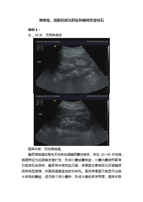 海绵肾、肾脏钙质沉积症和痛风性肾结石