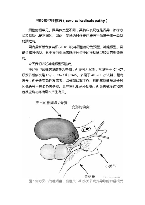 神经根型颈椎病（cervicalradiculopathy）