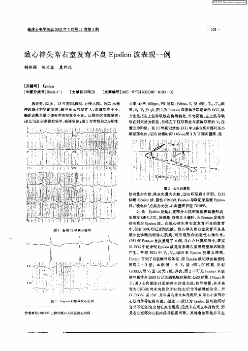 致心律失常右室发育不良Epsilon波表现一例