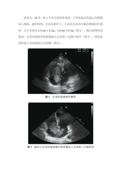 双心房黏液瘤超声表现