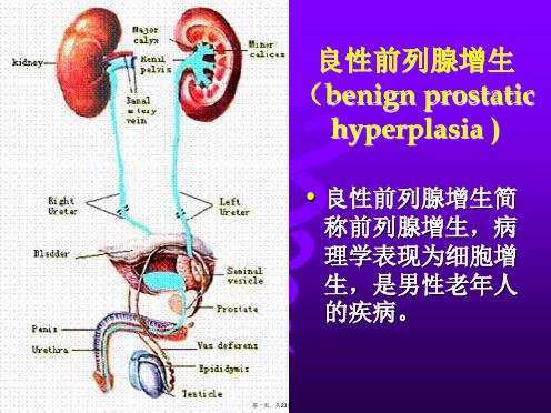 前列腺增生--教学查房