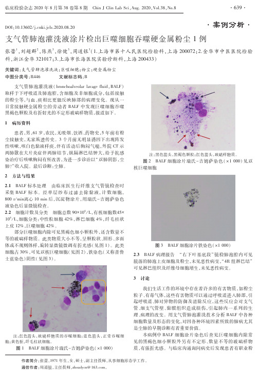 支气管肺泡灌洗液涂片检出巨噬细胞吞噬硬金属粉尘1例