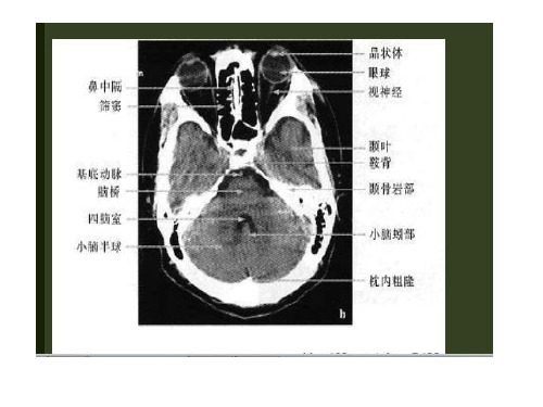 脑部CT图
