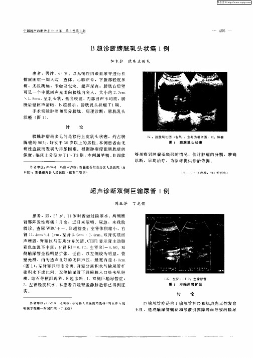 超声诊断双侧巨输尿管1例