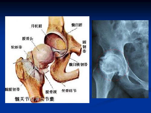 医学专题浅析股骨头无菌性坏死浅论