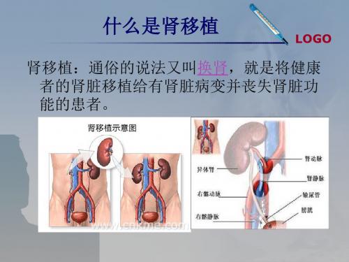 肾移植术后并发肺部感染护理查房