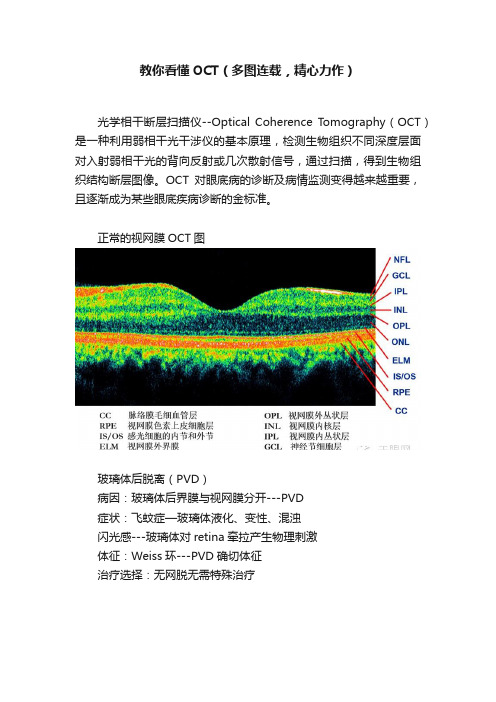 教你看懂OCT（多图连载，精心力作）