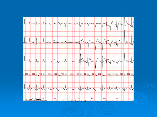 心电图常见正常和异常心电图图谱