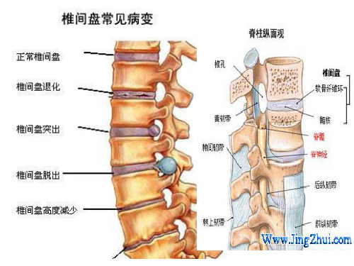 腰间盘突出引起的神经性损伤