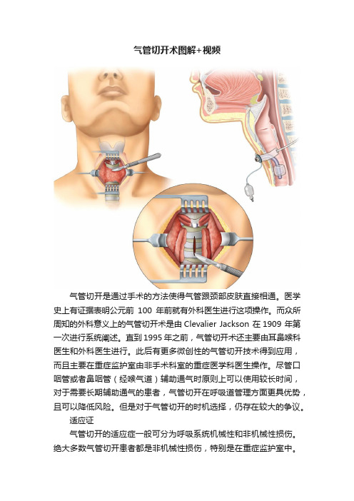 气管切开术图解+视频