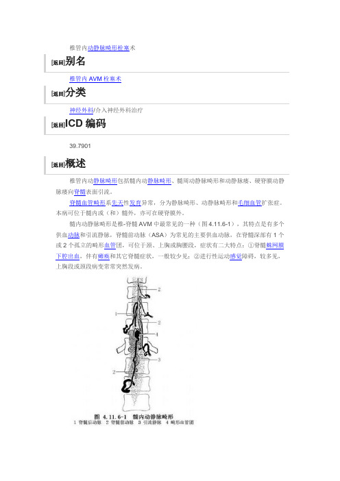 椎管内动静脉畸形栓塞术