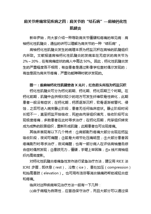 肩关节疼痛常见疾病之四：肩关节的“结石病”—肩袖钙化性肌腱炎