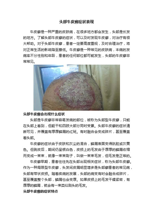 头部牛皮癣症状表现