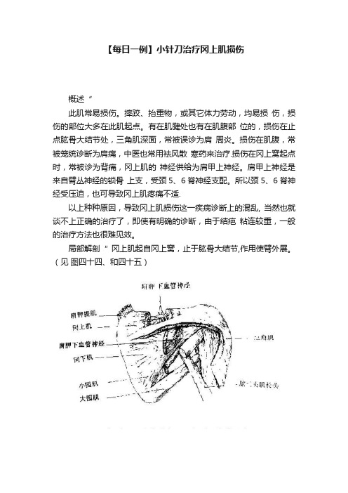 【每日一例】小针刀治疗冈上肌损伤