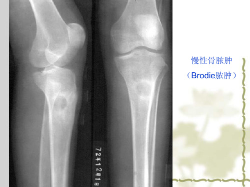 医学影像学课件骨巨细胞瘤和骨肉瘤影像表现