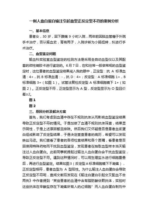 一例人血白蛋白输注引起血型正反定型不符的案例分析