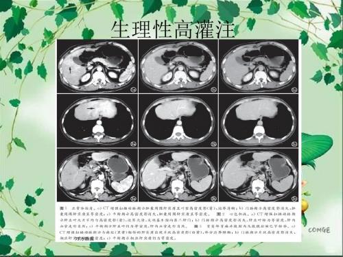 一过性肝脏CT灌注异常强化