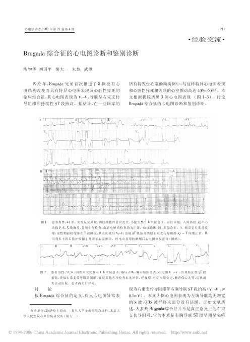 Brugada综合征的心电图诊断和鉴别诊断