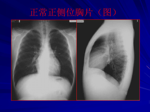 正常正侧位胸片(图精品PPT课件